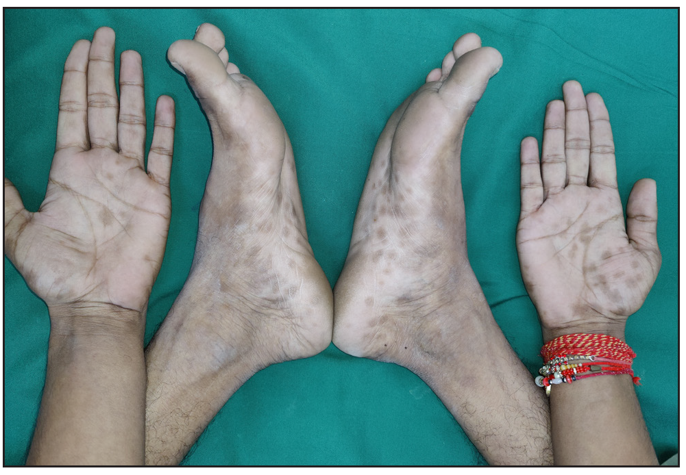 Multiple brownish hyperpigmented macules and papules over the palms and soles in a patient with secondary syphilis.