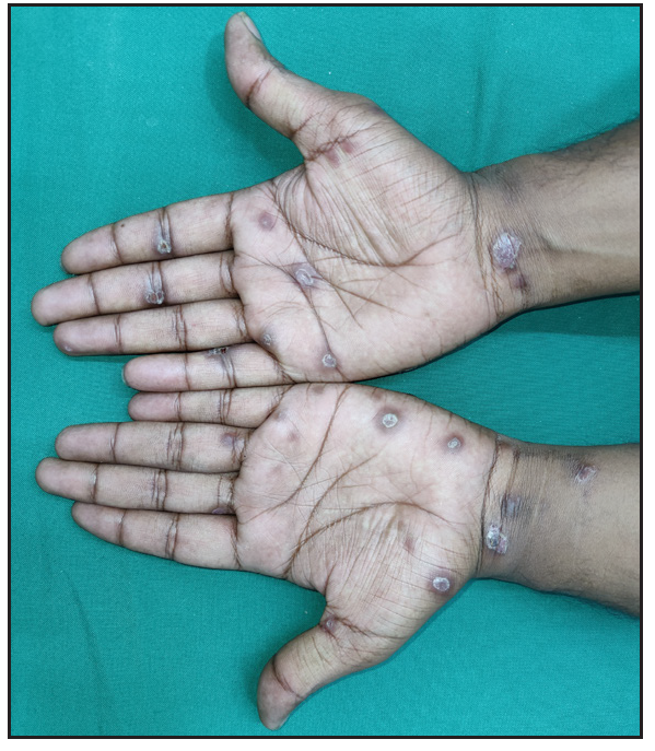 Multiple well-defined psoriasiform plaques over the palms in a patient with secondary syphilis.