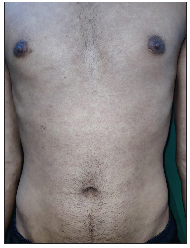 Copper-coloured macules over the trunk in a patient with secondary syphilis.