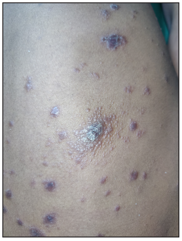 Multiple lichenoid papules and plaques in a Corymbose arrangement over the trunk in a patient with secondary syphilis.