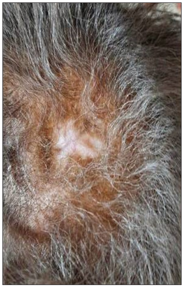 Scalp lesion resolved post-chemotherapy