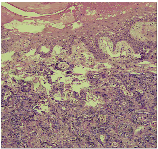The dermis shows infiltration by a metastatic carcinoma showing well-formed malignant glands. The epidermis is not involved in the tumour. (Haematoxylin and Eosin stain, 10x).