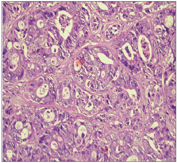 The malignant glands under higher magnification show a lining of atypical columnar epithelium showing nuclear stratification and mild nuclear pleomorphism. (Haematoxylin and Eosin stain, 20x).