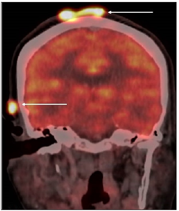 18F-fluorodeoxyglucose (FDG)-positron emission tomography (PET) Scan images showing metabolically active irregular heterogeneously enhancing soft tissue lesions in the scalp at the right high parietal (measuring 3.7 × 4.0 cm, Standardized Uptake Value (SUV) max 9.1) and, right s3upra-auricular region (measuring 1.6 × 1.0 cm, SUV max 11.4) as indicated by the white arrows.