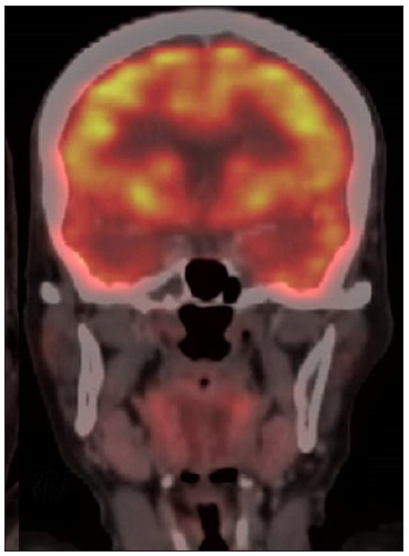 18F-fluorodeoxyglucose (FDG)-positron emission tomography (PET) Scan images showing follow-up PET/CT post-chemotherapy show interval resolution of the scalp lesions.
