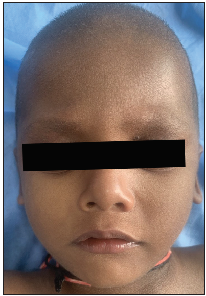 Diffuse sparsening of hair over scalp and eyebrows along with mild ichthyosis over the face.