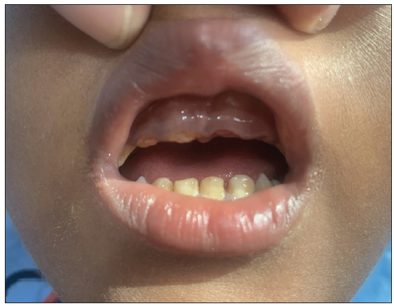 Dental enamel defect with hypodontia.