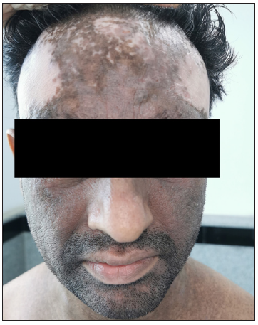 Baseline clinical photograph showing lichenified plaques on the face with depigmented areas.