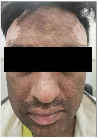 Improvement in the lichenified plaques after oral mini pulse and tofacitinib. Note the persistence of depigmentation.