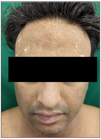 Sustained near-complete repigmentation at nine months follow-up after non-cultured epidermal suspension.