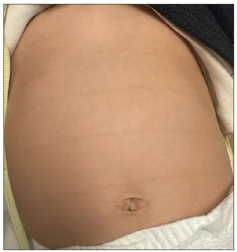 Multiple horizontal and parallel hyperpigmented lines following skin folds on the abdomen.