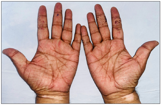 Multiple, discrete, dark reddish to brownish purpuric macules on the palmar aspects of both hands, mainly on the index and middle fingers slightly extending onto the dorsal aspect.