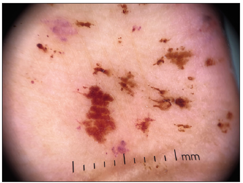 Violaceous and erythematous dots (recent petechial lesions); erythematous and brown dots and globules (old petechial lesions) (DermLite™ DL4; x10 polarised mode).