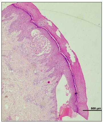 Epidermis displays compact orthokeratosis and spongiosis. The upper dermis shows perivascular infiltrate of lymphomononuclear cells and histiocytes with evidence of vasculitis. (Haematoxylin and eosin, 40x).