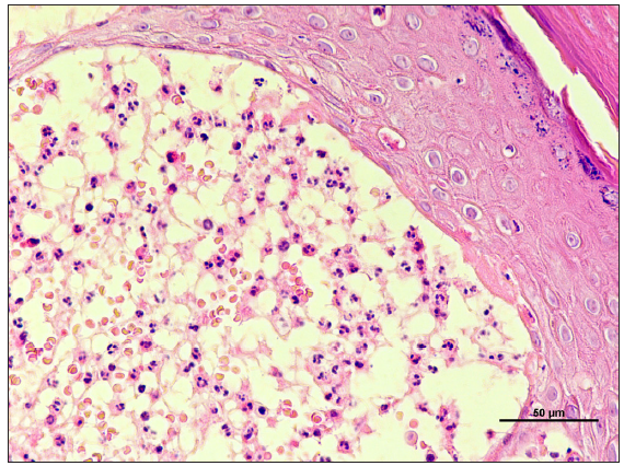 The upper dermis showing perivascular lymphomononuclear inflammatory infiltrate, and evidence of vasculitis in the form of prominent endothelial cells, extravasation of red blood cells, and neutrophilic infiltration. (Haematoxylin and eosin, 400x).