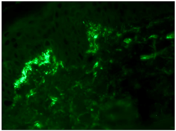 Direct immunofluorescence shows granular IgA deposition along the tip of dermal papillae. (Fluorescein isothiocyanate, 400x).