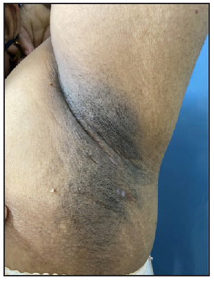 25-year-old female patient of HS with clinical Hurley stage I.