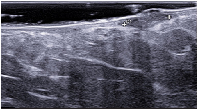 Hypodermal hyperechogenic oedema of fistulous tracts.