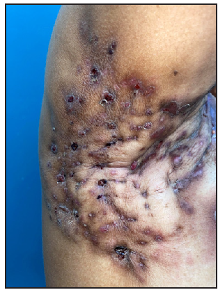 A 52-year-old female patient of HS with clinical Hurley stage II.