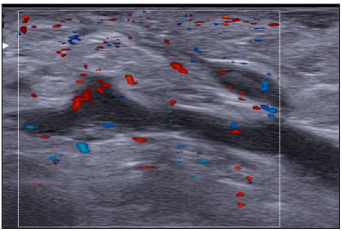 Moderate vascularisation at the periphery and internal of fistulous tracts on colour doppler (Dotted rectangle represents the area with vascularity within the active site of involvement).