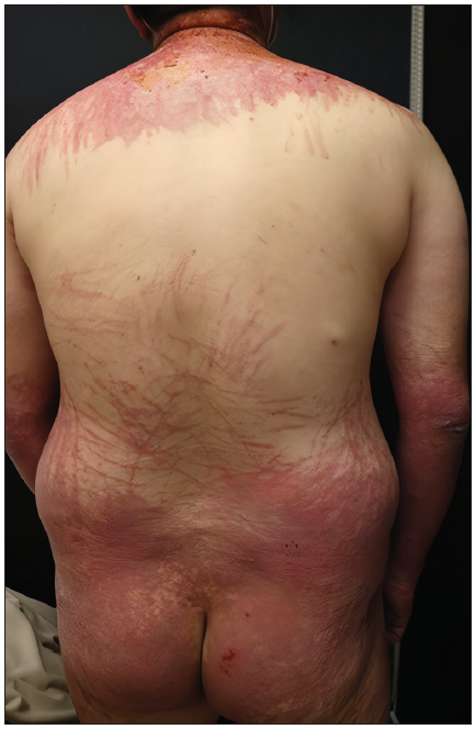 Flagellated streaks accompanied by shawl sign, and confluent patches on the buttocks with crusts on the upper back.