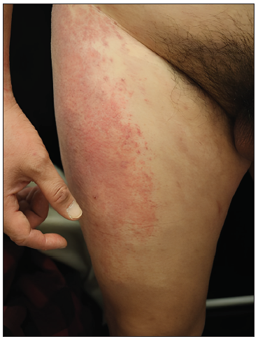 Erythematous patch on the lateral aspect of the thigh (Holster sign).