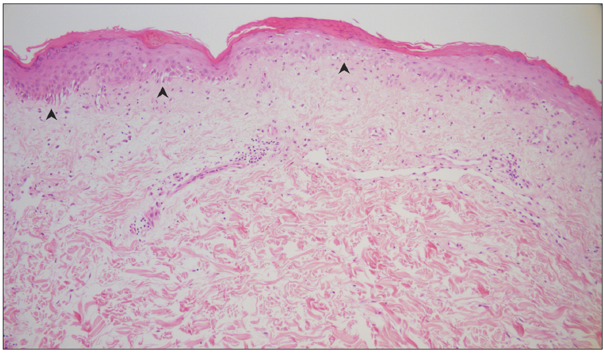 Parakeratosis, apoptosis, vacuolar degeneration (black arrowheads), superficial dermal oedema with superficial perivascular lymphoplasmacytic infiltration (Haematoxylin & eosin, 100x).