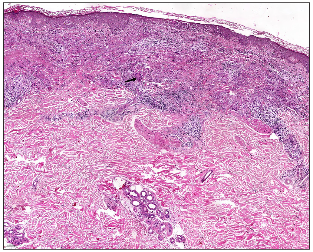 Fencing-like granulomatous inflammation characterized by epithelioid histiocytes and multinucleated giant cells surrounding the granuloma, as indicated by the black arrows (Haematoxylin and eosin, 10x).