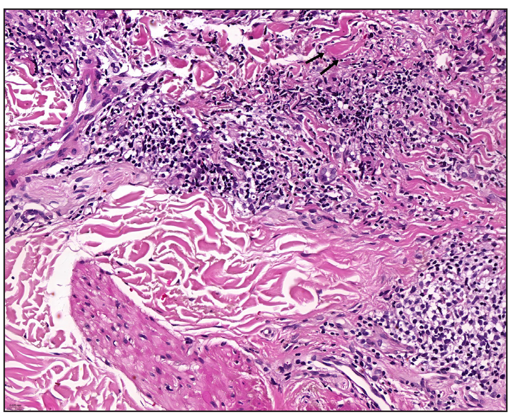 Horizontally oriented collagen bundles appear thickened and stained red, as indicated by the black arrows (Haematoxylin and eosin, 40x).