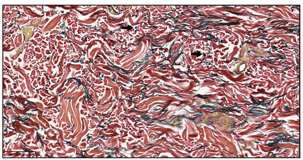 Verhoeff-Van Gieson (VVG) staining reveals localised disruption of elastic fibres in the superficial dermis, as indicated by the black arrows. (100x)