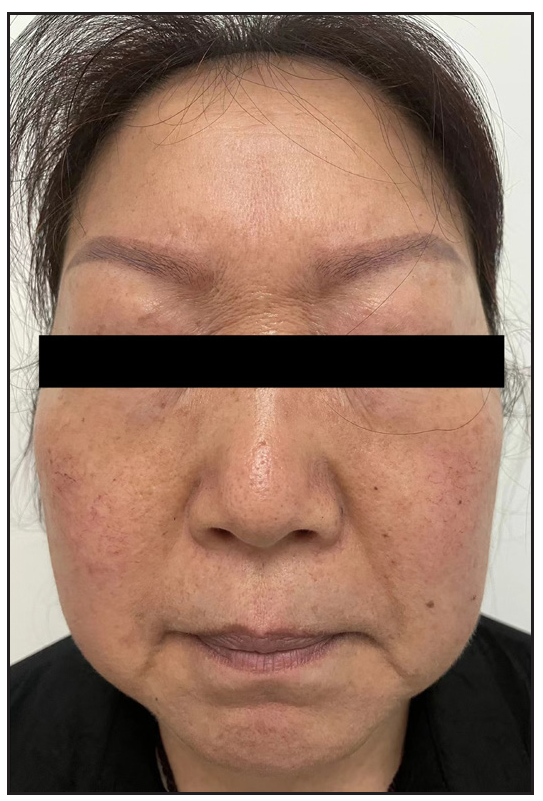 Post-treatment facial lesions demonstrate substantial resolution.