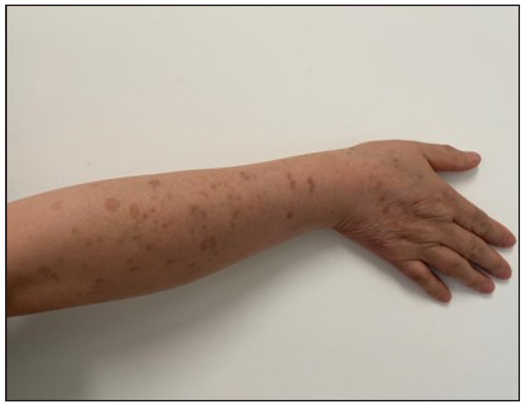 Post-treatment lesions on the patient’s right hand show scattered post-inflammatory hyperpigmentation.