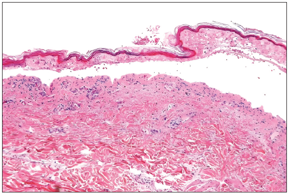 Histopathological examination shows epidermal necrosis with basal cell vacuolisation and numerous apoptotic keratinocytes with epidermal separation (Haematoxylin and Eosin, 100x).