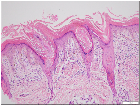 Histopathological examination of skin biopsy from the border of one of the lesions revealed focal invagination of epidermis with a column of parakeratosis, hypogranulosis and apoptotic keratinocytes (coronoid lamella) (Haematoxylin and eosin stain, 100x).