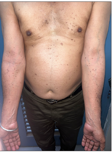 Decrease in the number of lesions over the trunk and upper limbs 6-months post treatment.