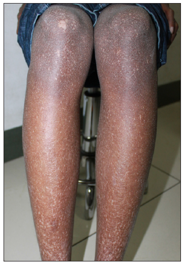 Reticulate hyperpigmentation and hypopigmented patches on lower limbs.