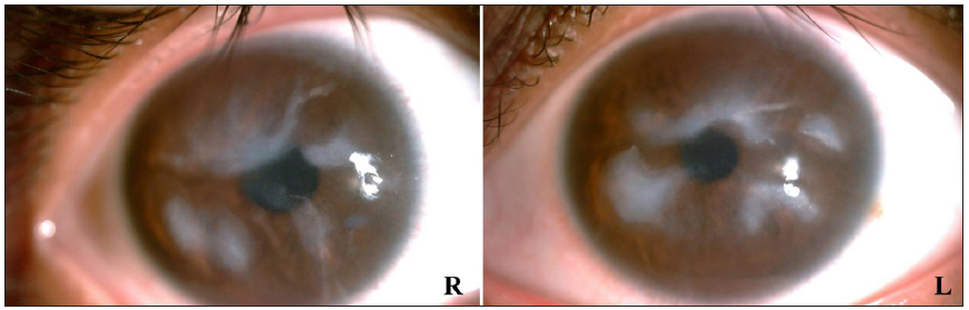 Anterior segment examination at slit-lamp exhibiting corneal opacities.