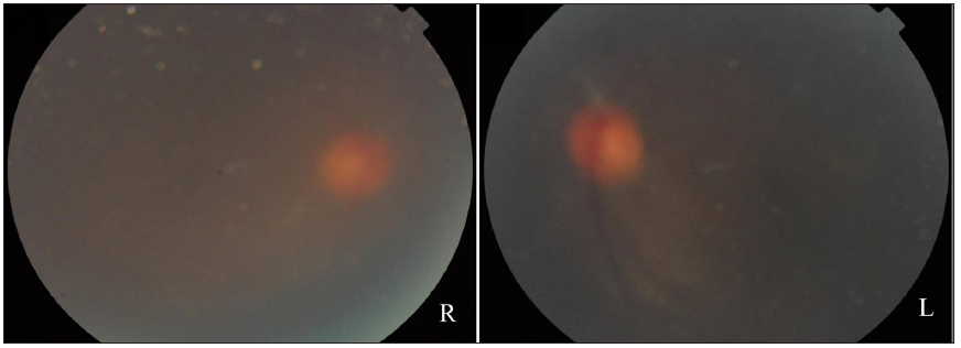 Fundus photography showing a blurred fundus with a faintly visible normal optic disc.