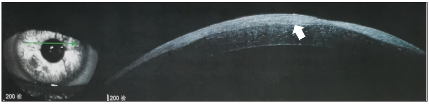 Optical coherence tomography revealing oedematous thickening of the cornea (arrow), involving the corneal epithelial layer and scarring.