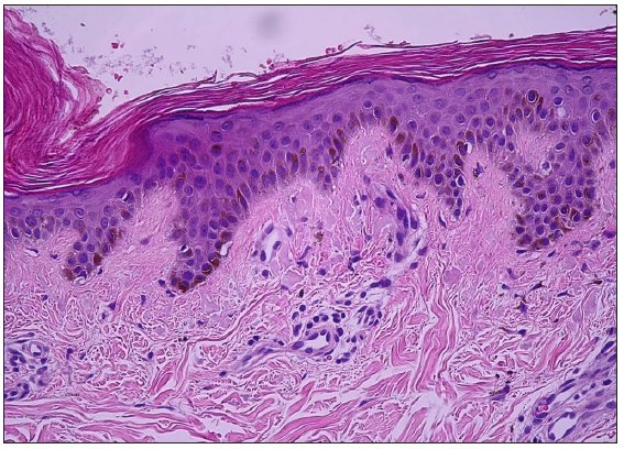 Mild epidermolytic hyperkeratosis, basal layer hyperpigmentation, and scattered melanophages in the dermal papillae (Haematoxylin and eosin, 200x).