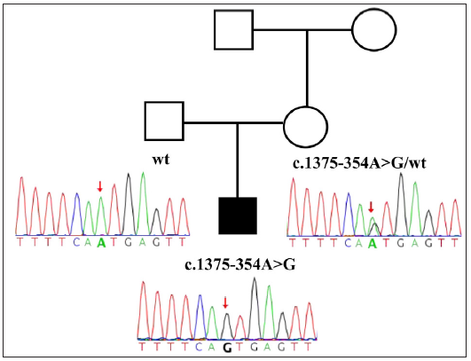 Sanger sequencing results of the patient and his parents. The red arrow indicates the position of the mutation in the sequence. (R: right; L: left. A: Adenosine, C: Cytosine, T: Thymine, G: Guanine).