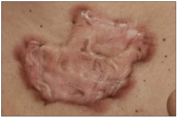 Baseline photo of keloid over chest.