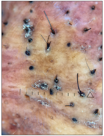 Dermoscopy (Illuco ILD-1100) shows hair tufts emerging from small pits and comedo-like structures (Polarised; 10x).