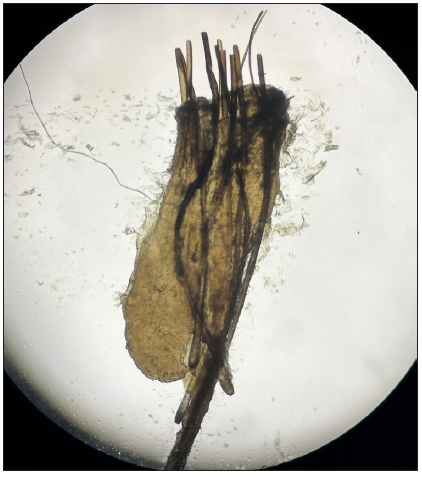 Microscopy of 10% potassium hydroxide (KOH) mount of the expressed follicular plug showing a bundle of short and stout hairs surrounded by a keratinous sheath (40x).