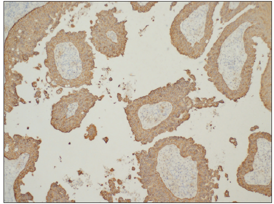 Columnar cells were positive for CK cocktail AE1/AE3 (AE1/AE3 Immunohistochemistry, 100x).