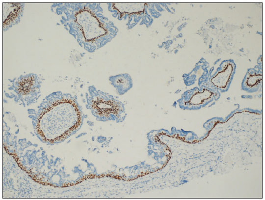 Cuboidal cells were positive for P63 (P63 Immunohistochemistry, 100x).