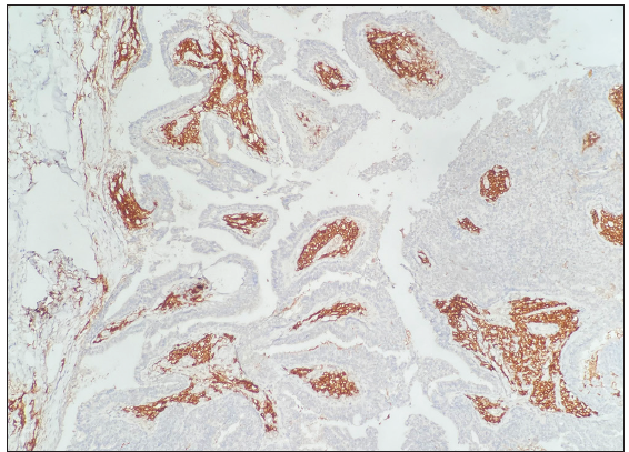 Plasma cells of the stroma were positive for CD38 (CD38 Immunohistochemistry, 100×).