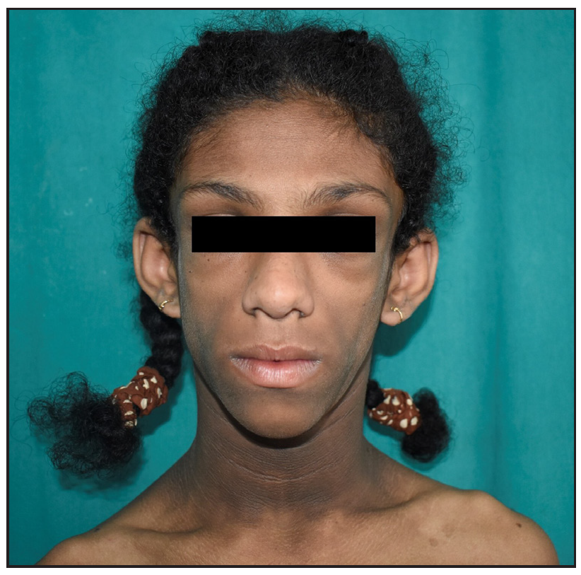 Cadaveric triangular facies, prognathism, and curly hair.