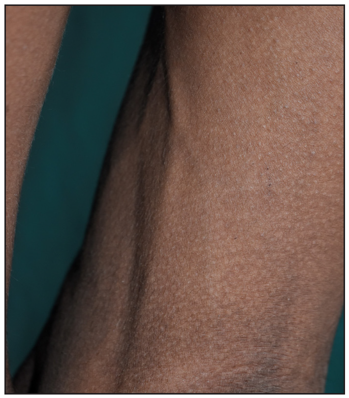 Prominent subcutaneous veins.