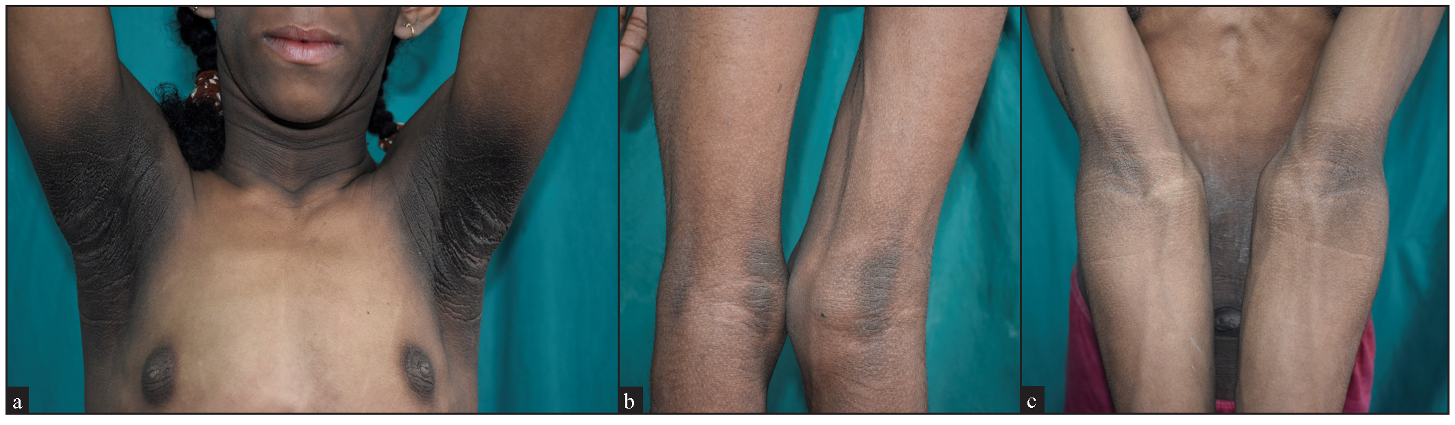 Thickened and hyperpigmented skin (Acanthosis nigricans) over (a) Neck and bilateral axillae, (b) Popliteal and (c) Anti-cubital fossae.